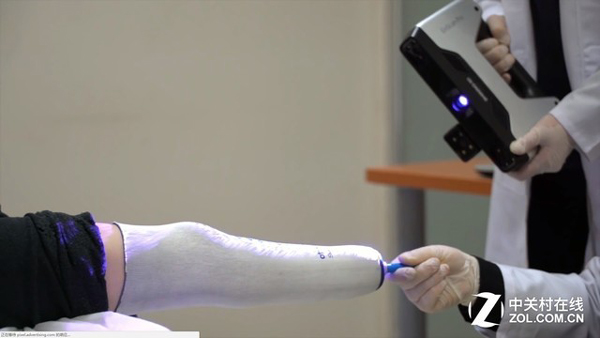 医生使用EinScan-Pro手持式3D扫描仪对病人的截肢部位进行扫描。