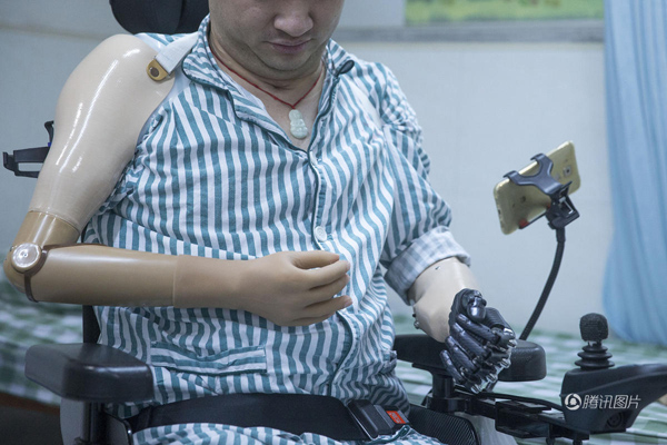 残疾人装上智能仿生手 能用电脑刮胡子